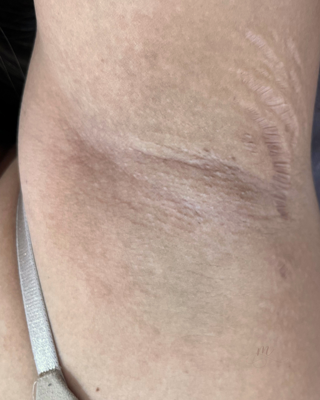 After — Underarm Angel White Laser