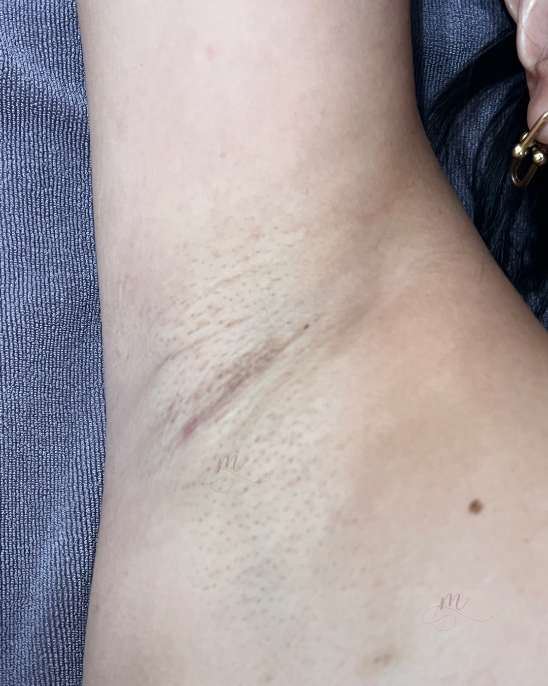 After — Underarm Angel White Laser