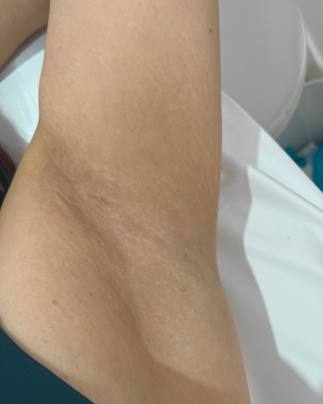 After — Skin Brightening Laser