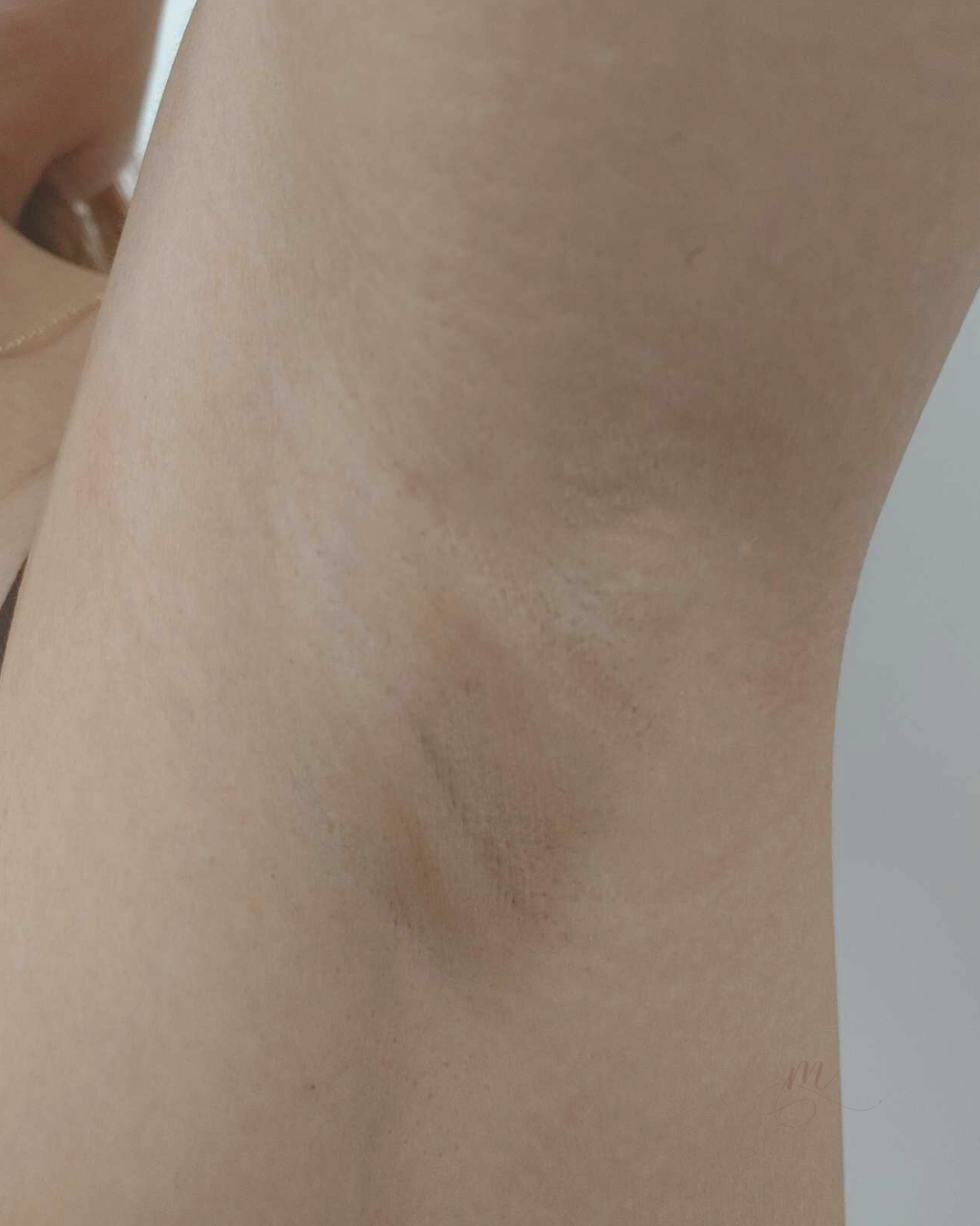 After — Melasma Laser Treatment