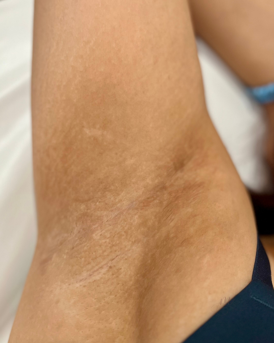 After — Laser Hair Removal