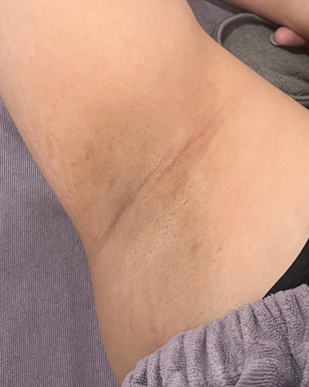 After — Microneedling Series