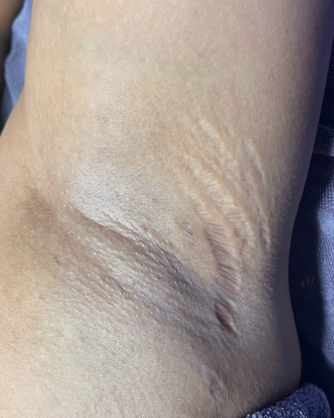 Before — Underarm Angel White Laser