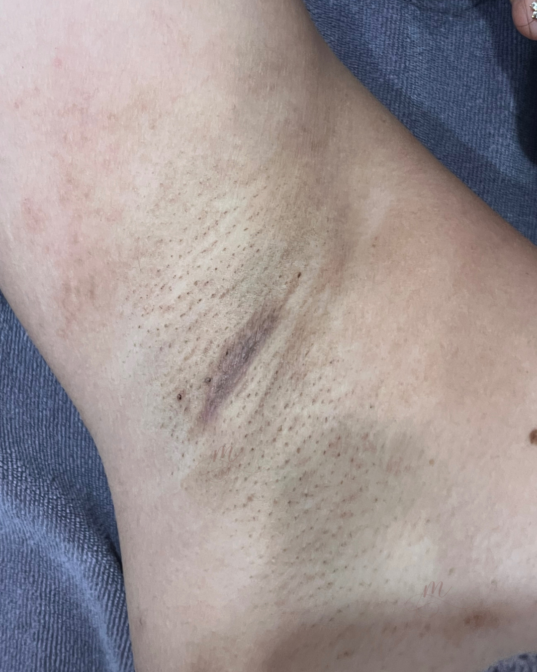 Before — Underarm Angel White Laser