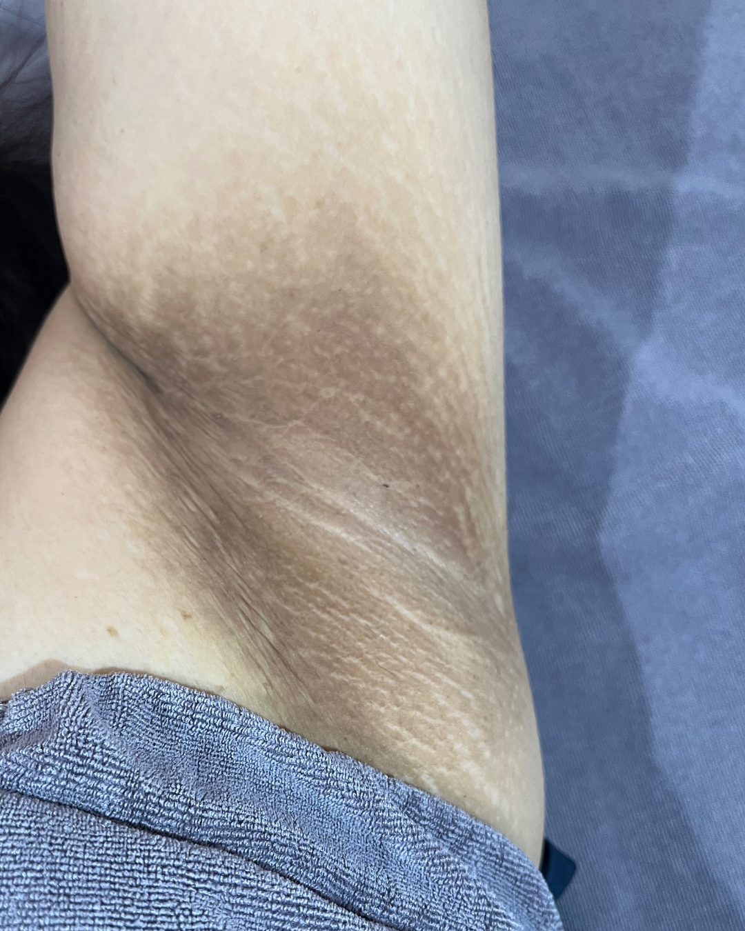 Before — Skin Brightening Laser