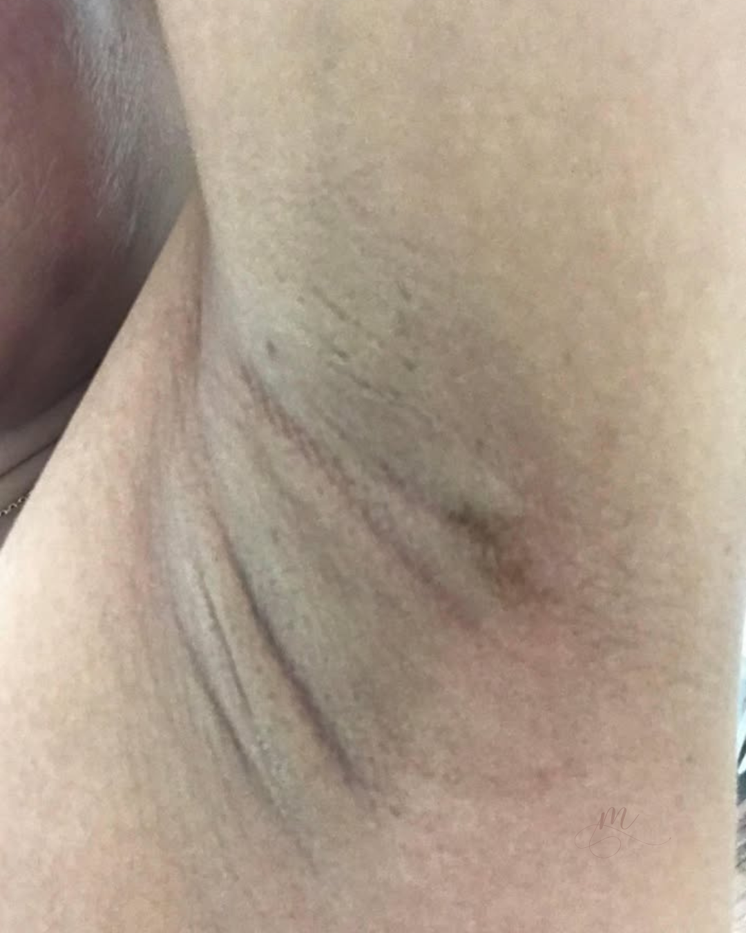 Before — Melasma Laser Treatment