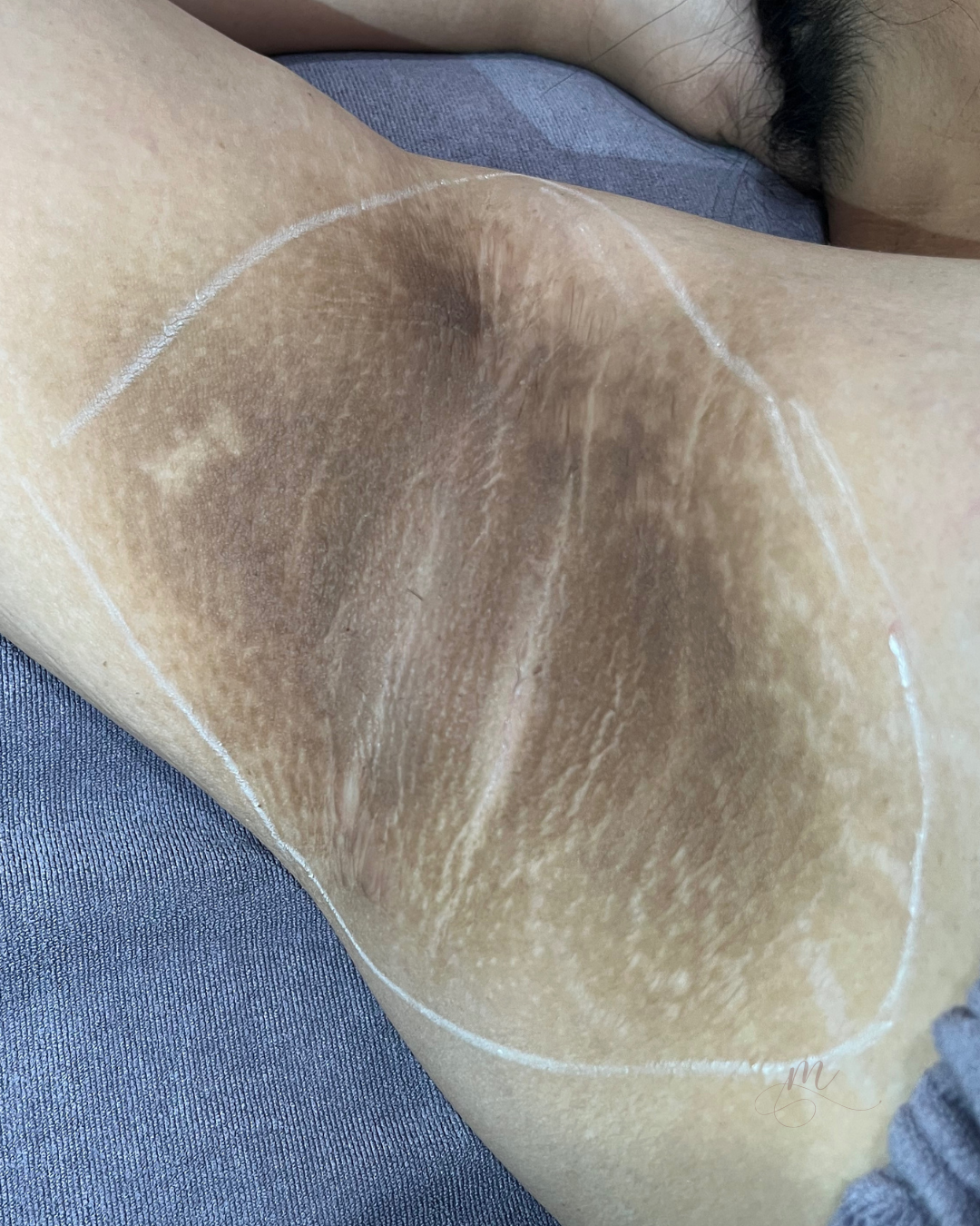 Before — Laser Hair Removal