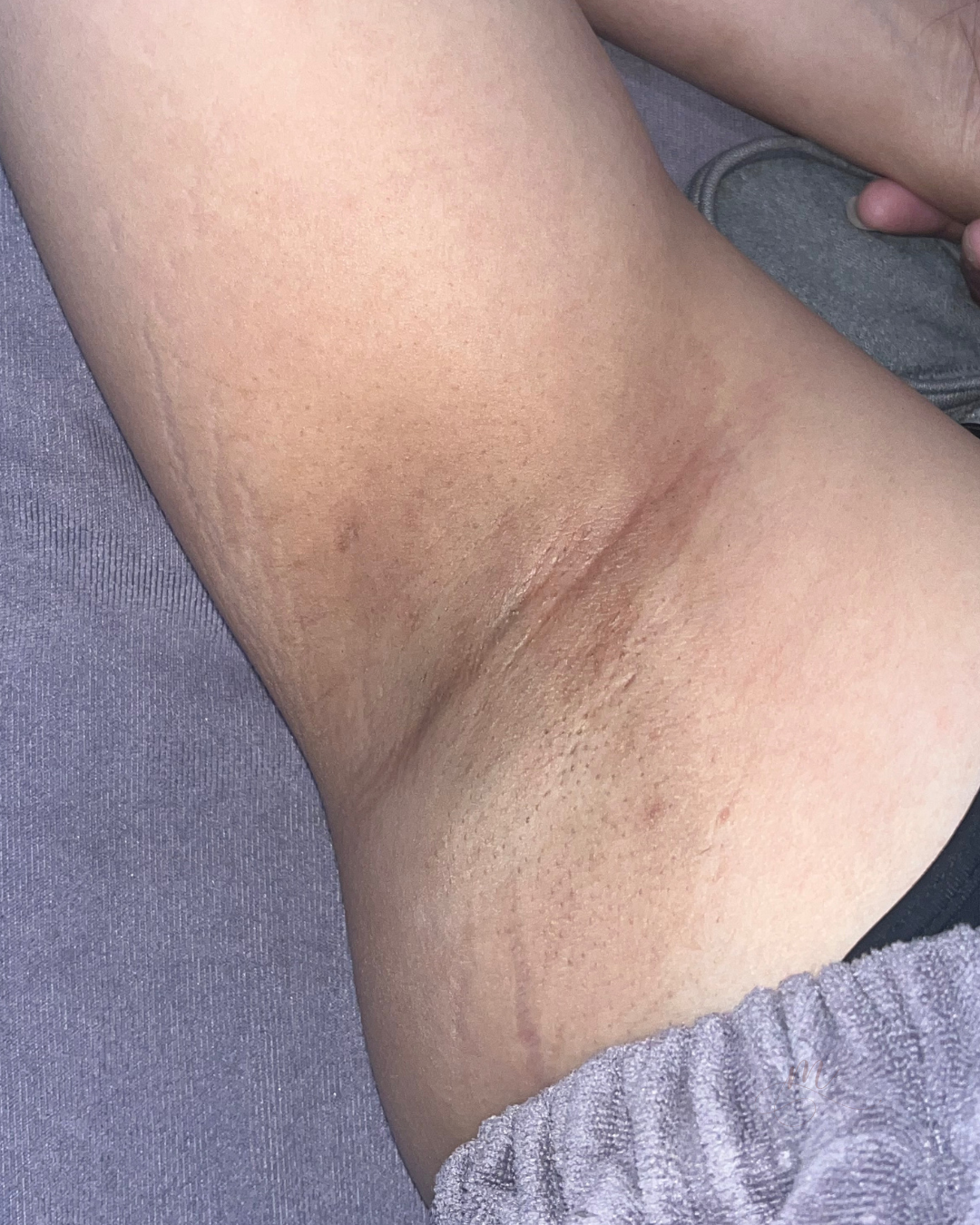 Before — Microneedling Series